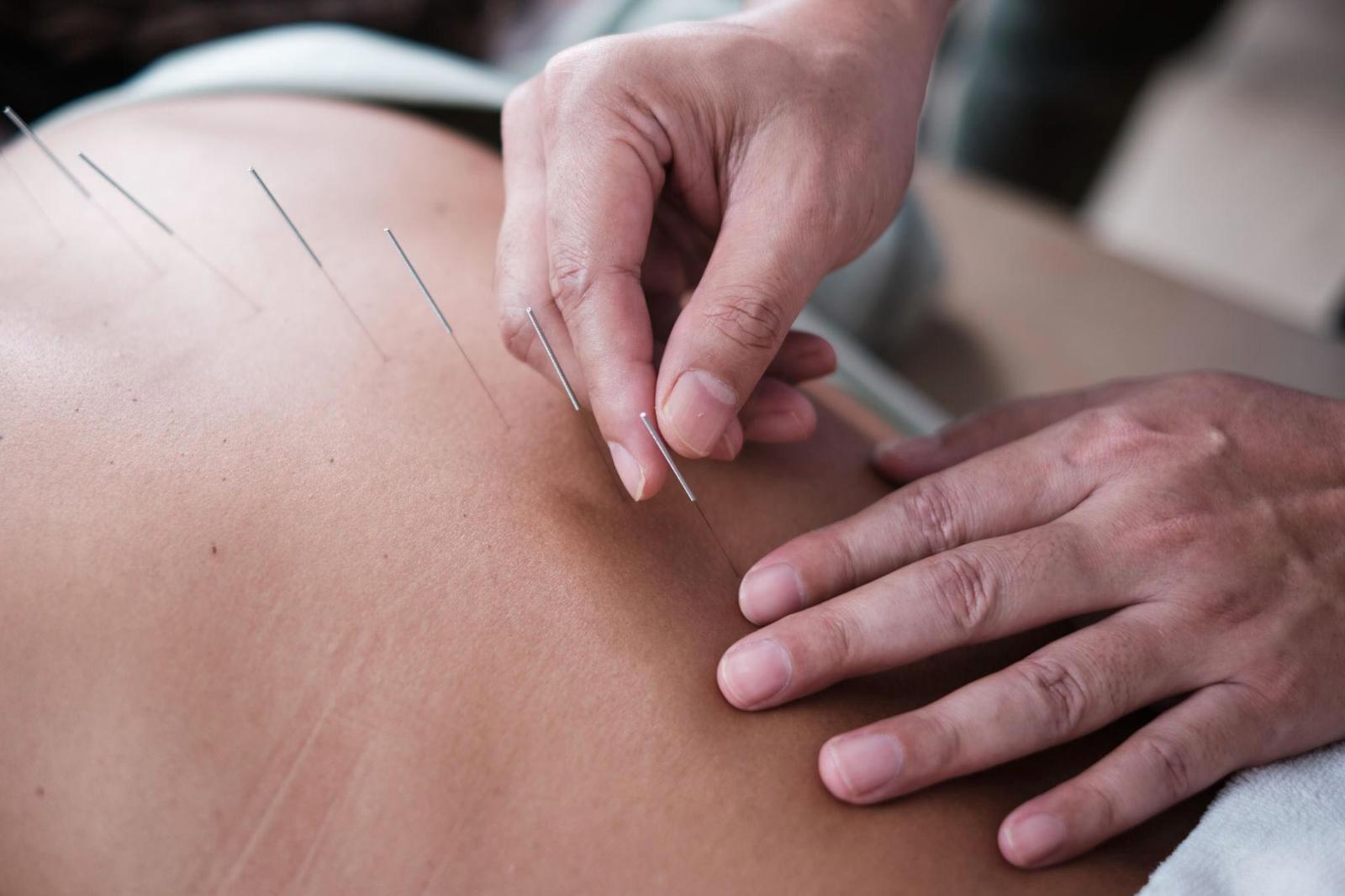 Applying acupuncture needled