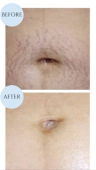 ScarโงRenewโขโจ treatment photograph