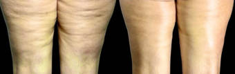 SilkโงSmoothโขโจ treatment photograph