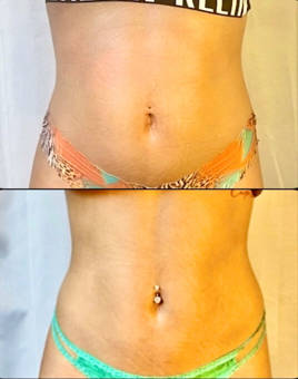 PhysiqueโงSculptโขโจ treatment photograph